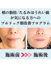 ボナボナ 仙台立町(BONA BONA)/顔のお肉とたるみを無くしたい！