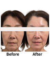 クリニカルスイート エーアール(Clinical sweet.ar)/艶肌　リフトアップと脂肪分解