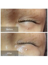 ヒール(heal)/40代　小じわ