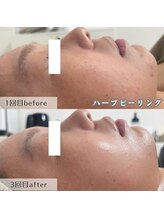 ネイルズビー 別邸(Nail's be)/肌荒れ/毛穴改善