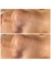 ティアーナ(Tiaana)/毛穴洗浄