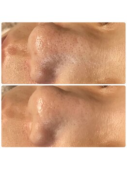 ティアーナ(Tiaana)/毛穴洗浄