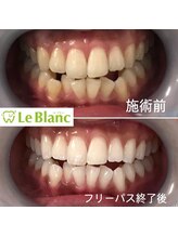 ルブラン 奈良店(Le Blanc)/日に日に変わる歯のお色！