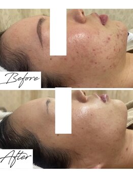 ビズビズ 梅田店(bisebise)/〈症例〉ニキビケア・赤み・跡