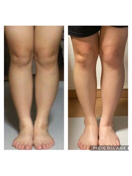 クリスタル(CRYSTAL)/【セル脂肪撃退】下半身コース