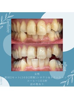 ブランコ 浦和駅前店(Blanco)/詰め物があってもOK ！