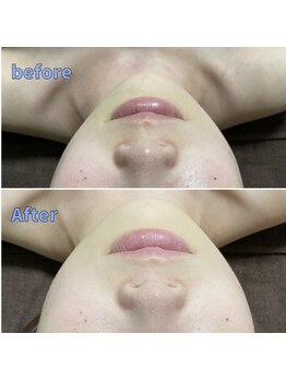 ゼロ 水戸店(ZERO)/シミ・シワ改善スペシャル300