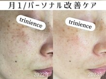 トリニエンス 新宿店(TRINIENCE)/40代/シミケア/パーソナルケア