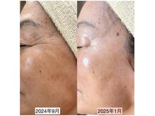 トリートメントサロンビューティープラス(Treatment Salon Beauty+)の雰囲気（光フェイシャルは目尻の深くなったシワ改善や予防にもなります）