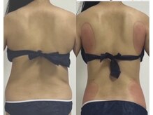 プリマルーチェ/プレミアム背中プログラム