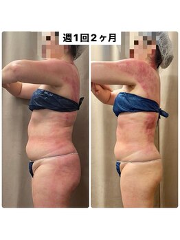 スピード美人 柏店/週1施術でこの変化