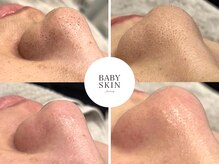 ベイビースキンファクトリー(BABY SKIN FACTORY)の雰囲気（上Befor/下Afterです☆トーンアップ、つるつるの水光肌に）