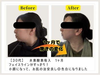 ヨサ パーク モモ(YOSA PARK MOMO)/小顔、美肌にも水素が◎