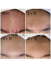 プラセル(Placer)/もう戻らない！！