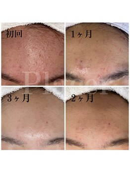 プラセル(Placer)/もう戻らない!!