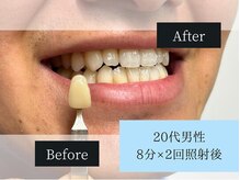 ホワイトニングカフェ 原宿店/◎歯のホワイトニング施術写真◎