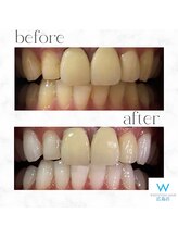 ホワイトニングショップ 広島店(WHITENING SHOP)/【ホワイトニング】Before After