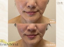 ジゼル(Giselle)/【レモンボトル】お客様B＆A