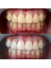 ワールドビューティー(World Beauty)/プレミアムホワイトニング6回