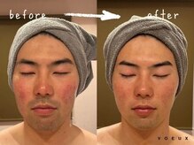 ボウ 静岡本店(VOEUX)/にきび・髭脱毛　20回