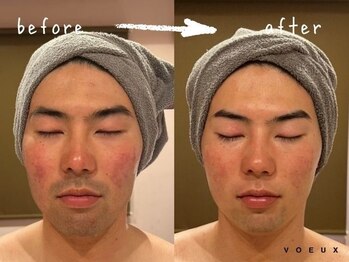 ボウ 静岡本店(VOEUX)/にきび・髭脱毛 20回