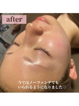 スピカ(Spica)/ニキビケア改善プログラムafter