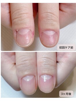 カピリナ(Ka Pilina)/自爪育成