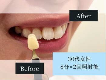 ホワイトニングカフェ 原宿店/◎歯のホワイトニング施術写真◎