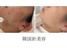 【1番人気！】最強ニキビケア◎稀少なスゴ技!￥29800→￥19800