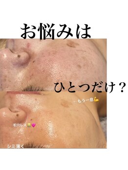 サロンツキ(salon tuki)/光フォト症例