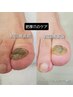 【誰でもＯＫ】変形・厚み・固くて切れない爪のケア　5,500円