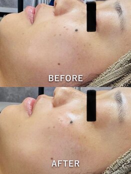 ルーク(Luke)/毛穴ケア