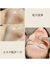 【毛穴洗浄＋エステ版ダーマ】肌洗浄と肌活性一気に叶う！肌老化に狙いうち！