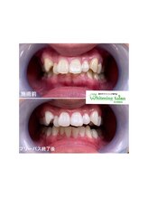 ホワイトニングサロン 名古屋駅店/【ホワイトニング施術例】