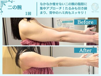 フローフシ∞/【脂肪】二の腕・背中ハミ肉撃退