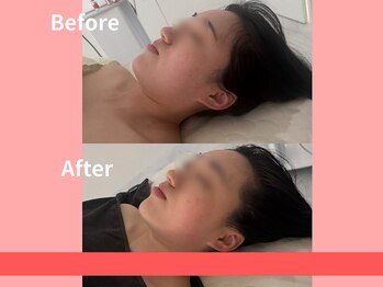 オーダーメイド痩身&小顔矯正専門店Re:Lives【リライブ】金町店/レッドショット小顔美肌