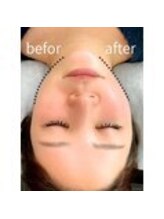 小顔・痩身専門店Lift（リフト）練馬/小顔専門店Lift|Before After