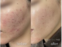 ミレット(Miretto)/【ニキビ・赤み】水光ピーリング