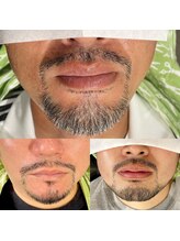 ビアンカ(BIANCA)/石岡市姉妹店HAIKARASANヒゲ脱毛