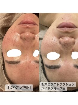 グラン ジュテ/毛穴ケア