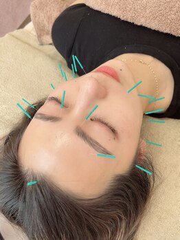 ヒーリングサロン アージュ(A-je)/★美顔鍼＋小顔矯正★