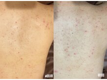 フルール(Fleur)/■背中トリートメント■