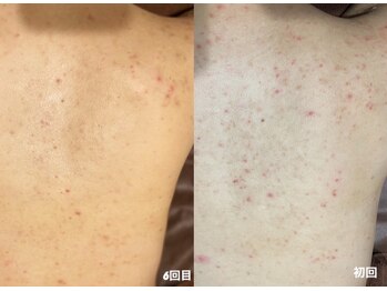 フルール(Fleur)/■背中トリートメント■