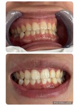 エクシアホワイトニング 奥田店/ホワイトニングビフォーアフター