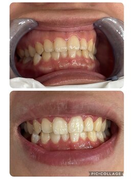 エクシアホワイトニング 奥田店/ホワイトニングビフォーアフター