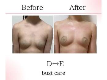 サロンツキ(salon tuki)/バストケア症例