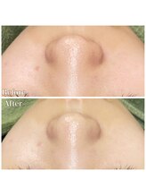 ちらちゅら/ハイドロ毛穴洗浄