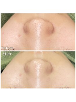 ちらちゅら/ハイドロ毛穴洗浄