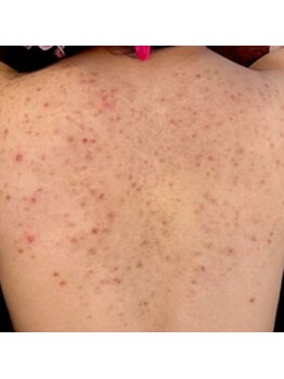 リベル 名古屋(Lebelle:)/ハーブピーリング専門 名古屋