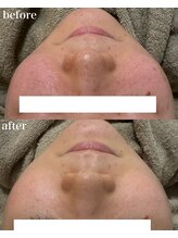 モンクラッシー(Mon classy)/6回施術後